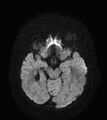 Aicardi syndrome (Radiopaedia 66029-75205 Axial DWI 9).jpg