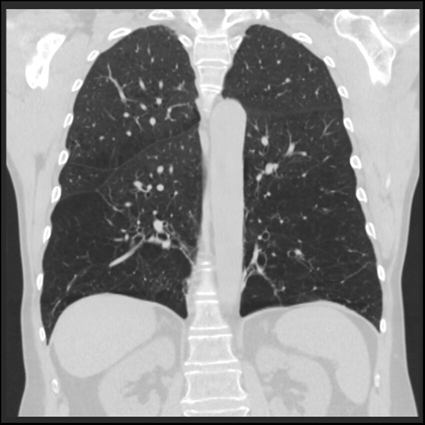 Alpha-1-antitrypsin deficiency (Radiopaedia 40993-43722 Coronal lung window 69).jpg