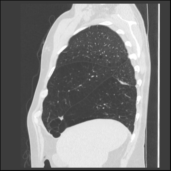 File:Alpha-1-antitrypsin deficiency (Radiopaedia 40993-43722 Sagittal lung window 221).jpg