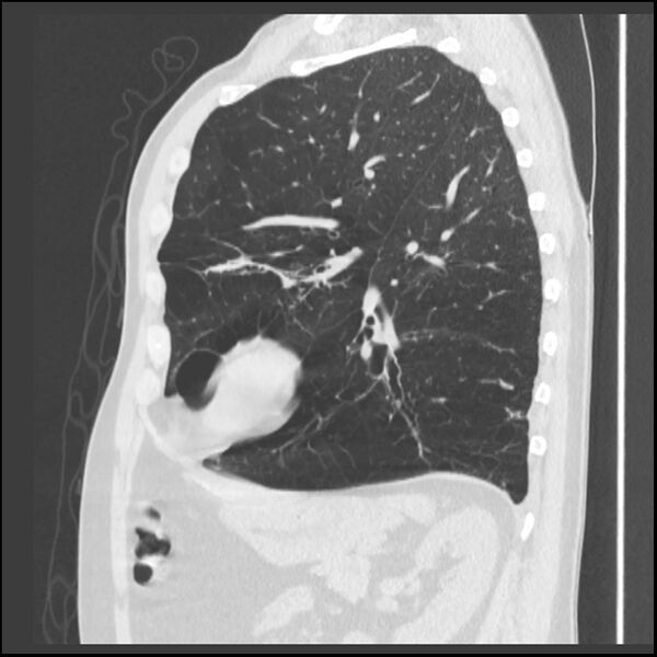 File:Alpha-1-antitrypsin deficiency (Radiopaedia 40993-43722 Sagittal lung window 86).jpg