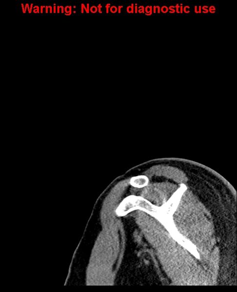 File:Ameloblastoma (Radiopaedia 33126-34164 Sagittal bone window 1).jpg
