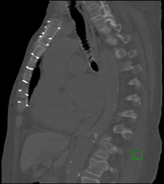 File:Amiodarone deposition in the liver (Radiopaedia 77587-89780 Sagittal bone window 48).jpg