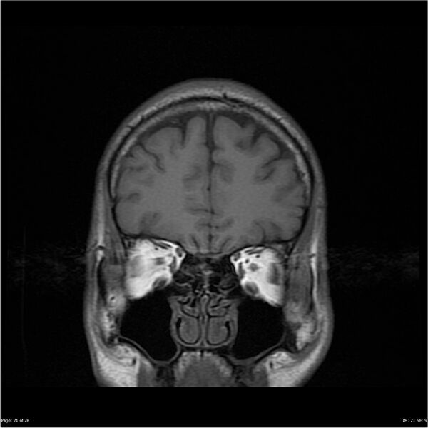 File:Amnestic syndrome secondary to hypoxic brain injury (Radiopaedia 24743-25004 B 21).jpg