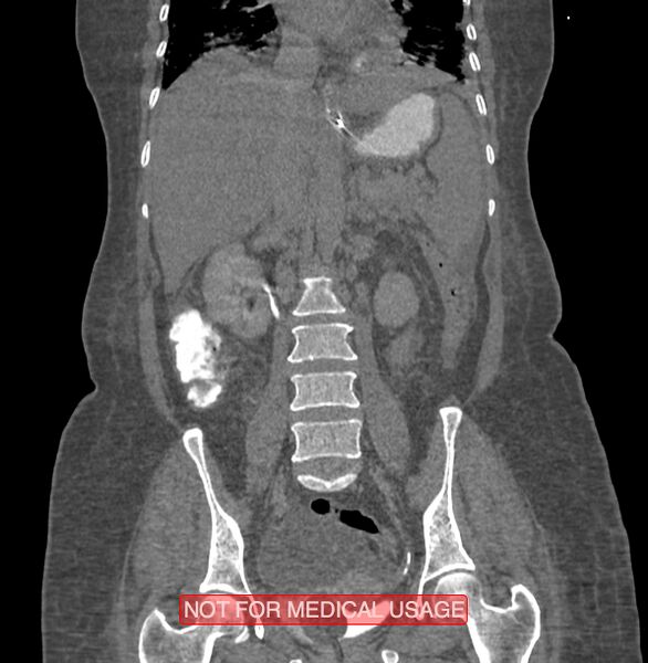 File:Amoebic enterocolitis with liver abscess (Radiopaedia 35100-36609 B 118).jpg