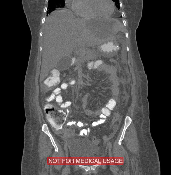 File:Amoebic enterocolitis with liver abscess (Radiopaedia 35100-36609 B 69).jpg