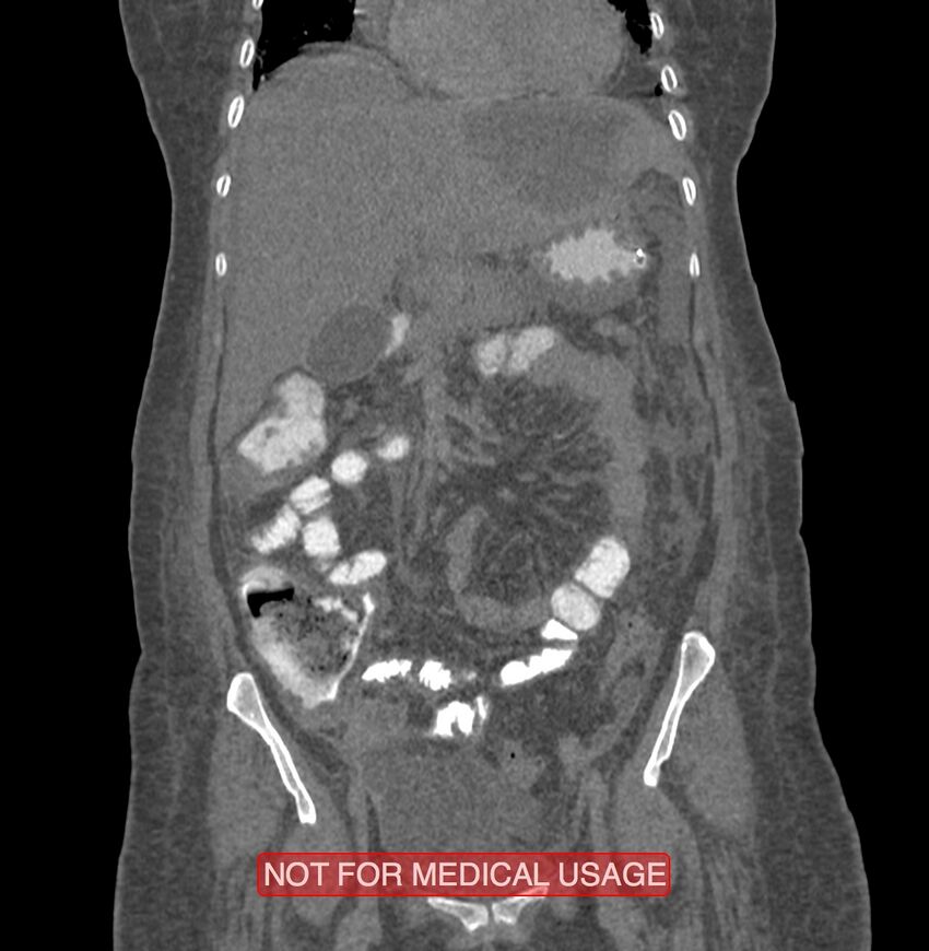 Amoebic enterocolitis with liver abscess (Radiopaedia 35100-36609 B 69).jpg