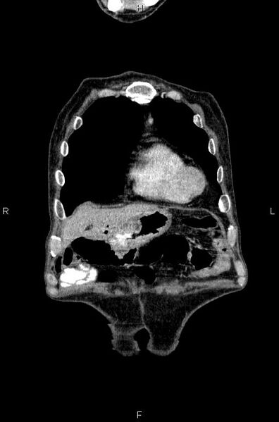 File:Ampullary adenocarcinoma (Radiopaedia 86093-102033 D 7).jpg