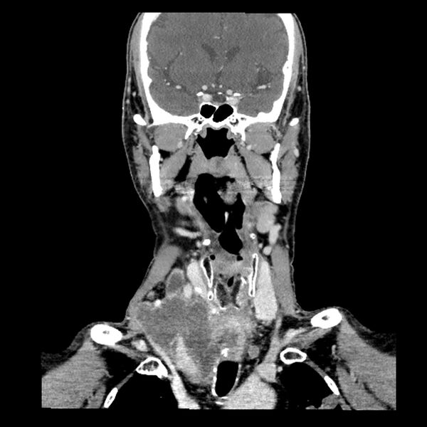 File:Anaplastic thyroid carcinoma (Radiopaedia 79087-92034 A 57).jpg