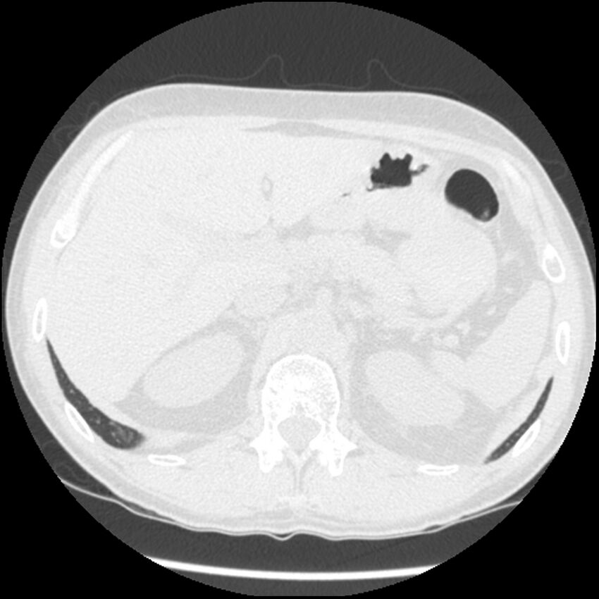 Angioinvasive aspergillosis (Radiopaedia 43957-47466 Axial lung window 68).jpg