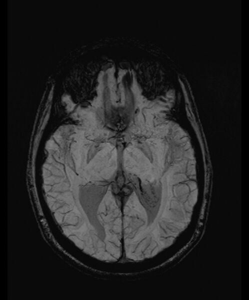 File:Angiomatous meningioma (Radiopaedia 79459-92579 E 32).jpg