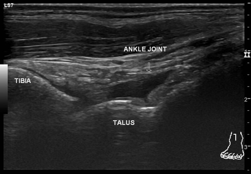 File:Ankle ligaments injury (Radiopaedia 86361).jpg