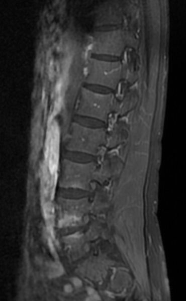 File:Ankylosing spondylitis - Andersson lesion (Radiopaedia 81878-95838 F 4).jpg