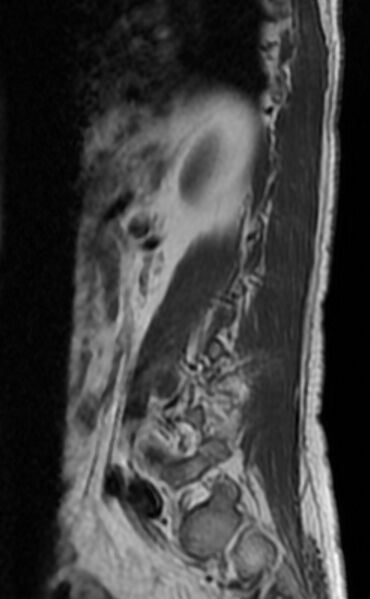 File:Ankylosing spondylitis - Andersson lesion (Radiopaedia 81878-95838 Sagittal T1 11).jpg