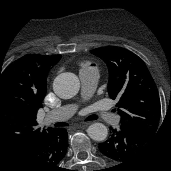 File:Anomalous origin of left circumflex artery from right coronary sinus (Radiopaedia 72563-83117 B 18).jpg