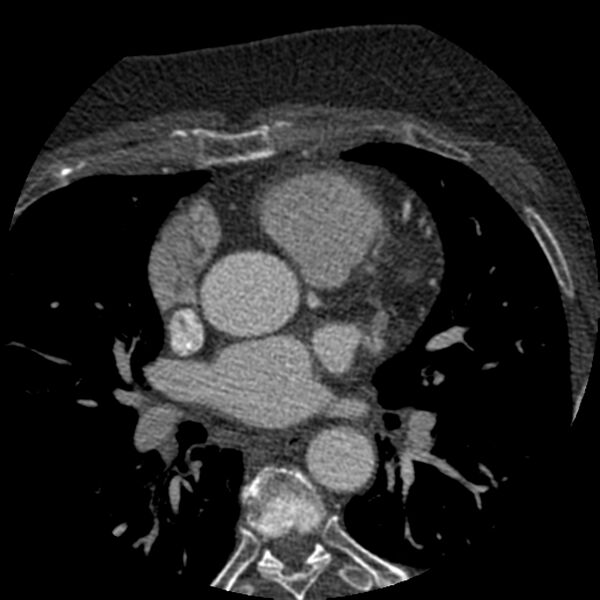 File:Anomalous origin of left circumflex artery from right coronary sinus (Radiopaedia 72563-83117 B 40).jpg