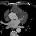 Anomalous origin of the left coronary artery with malignant course (Radiopaedia 77842-90126 C 85).jpeg