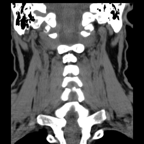 File:Anterior cervical postdiscectomy arthrodesis (Radiopaedia 32678-33646 Coronal non-contrast 23).jpg
