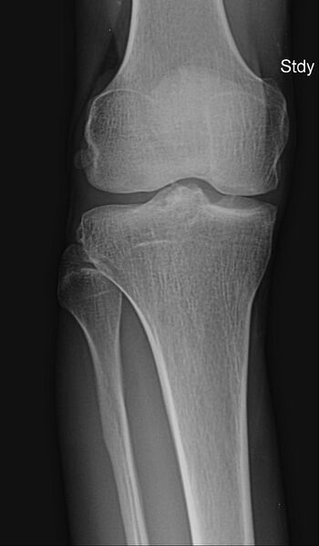 File:Anterior cruciate ligament bony avulsion (Radiopaedia 9241-9925 B 1).JPG
