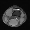 Anterior cruciate ligament full thickness tear (Radiopaedia 66268-75467 Axial PD fat sat 3).jpg