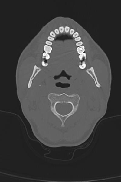 File:Anterior nasal spine fracture (Radiopaedia 46138-50494 Axial bone window 62).png