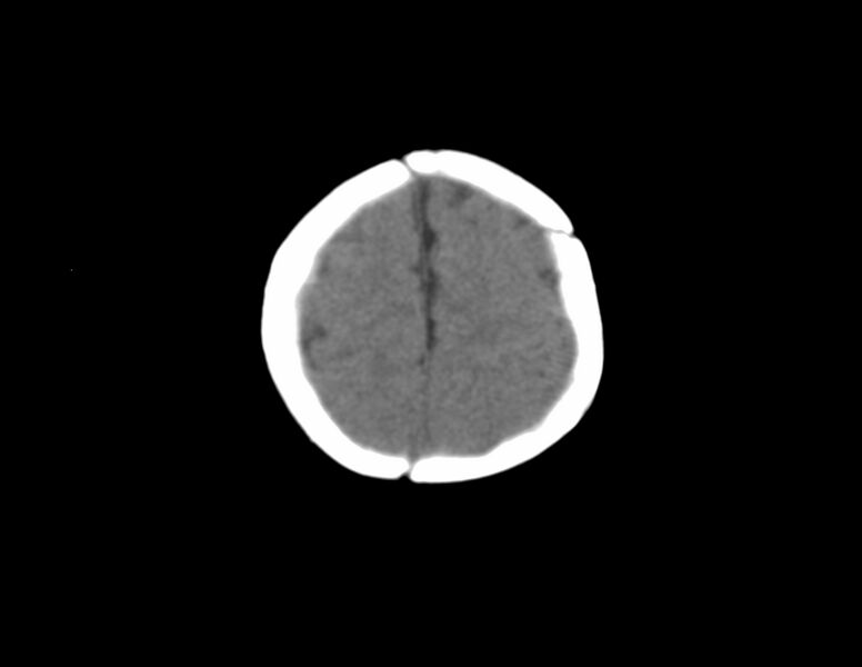 File:Anterior plagiocephaly (Radiopaedia 71836-82273 Axial non-contrast 18).jpg