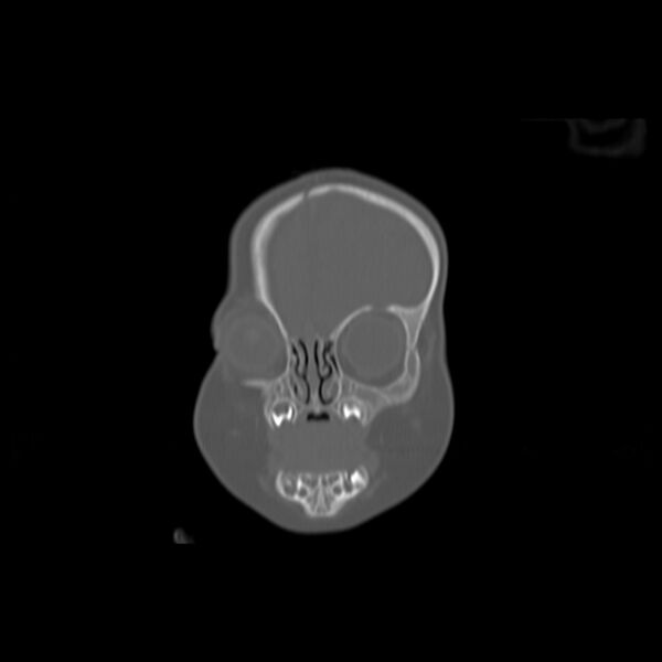 File:Anterior plagiocephaly (Radiopaedia 71836-82273 Coronal bone window 16).jpg