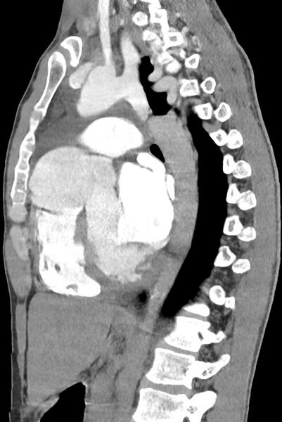 File:Aortic coarctation with aneurysm (Radiopaedia 74818-85828 B 92).jpg