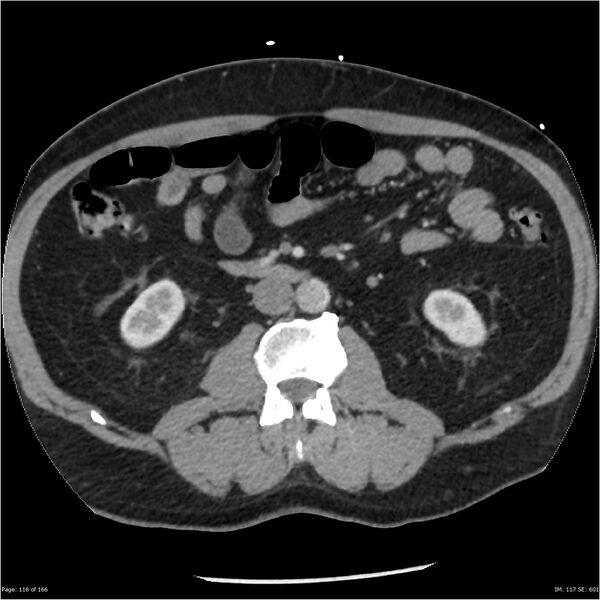 File:Aortic dissection- Stanford A (Radiopaedia 37759-39664 A 107).jpg