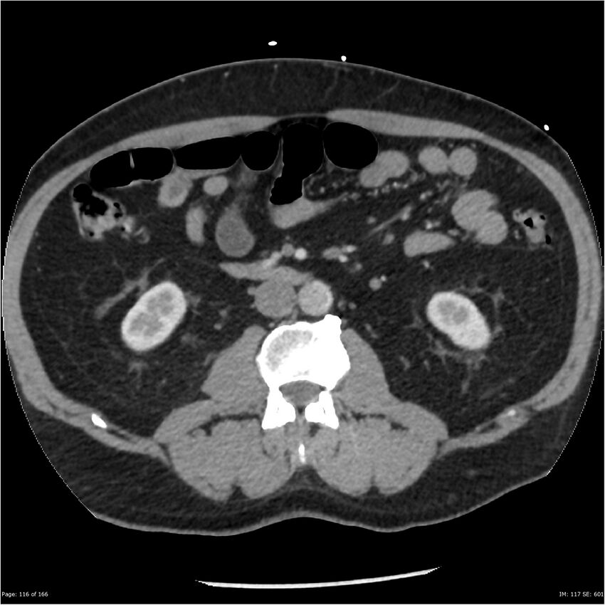 Aortic dissection- Stanford A (Radiopaedia 37759-39664 A 107).jpg