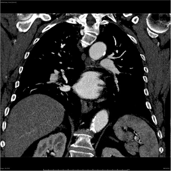 File:Aortic dissection - Stanford type A (Radiopaedia 26183-26315 A 43).jpg