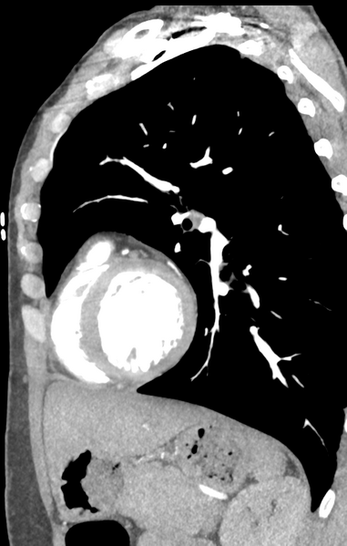 File:Aortic valve non-coronary cusp thrombus (Radiopaedia 55661-62189 C+ arterial phase 15).png