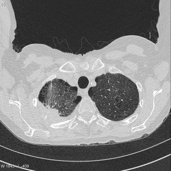 File:Apical non-small-cell lung cancer (Radiopaedia 8570-9405 Axial lung window 6).jpg
