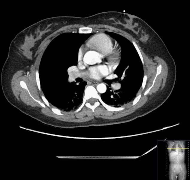 File:Appendicitis (CT angiogram) (Radiopaedia 154713-127660 Axial 202).jpg