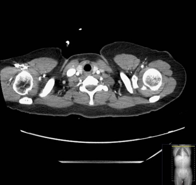 File:Appendicitis (CT angiogram) (Radiopaedia 154713-127660 Axial 247).jpg