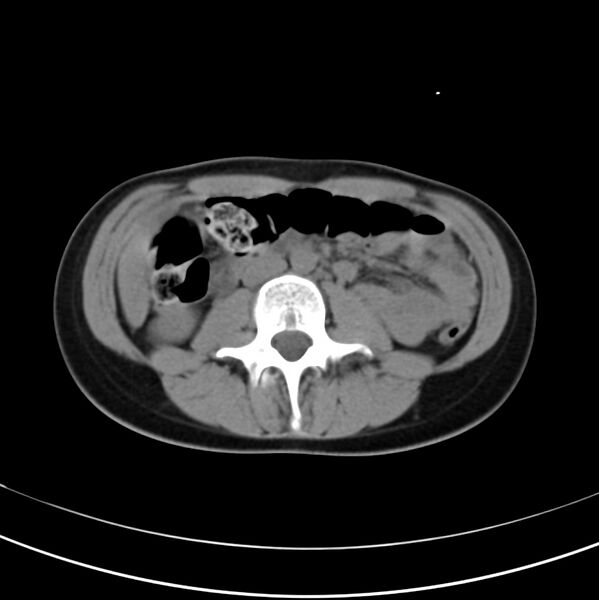 File:Appendicitis and incidental bicornuate uterus (Radiopaedia 22833-22853 Axial non-contrast 22).jpg