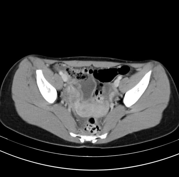 File:Appendicitis and incidental bicornuate uterus (Radiopaedia 22833-22853 B 39).jpg