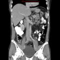 Appendicitis and renal cell carcinoma (Radiopaedia 17063-16760 B 15).jpg