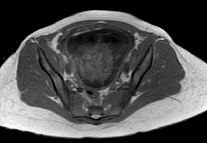 File:Appendicitis in gravida (MRI) (Radiopaedia 89433-106395 Axial T1 in-phase 57).jpg