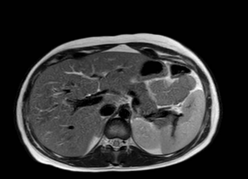 File:Appendicitis in gravida (MRI) (Radiopaedia 89433-106395 Axial T2 13).jpg