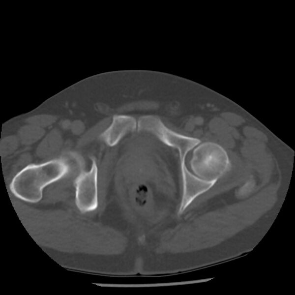 File:Appendicitis with perforation (Radiopaedia 35790-37342 Axial bone window 52).jpg