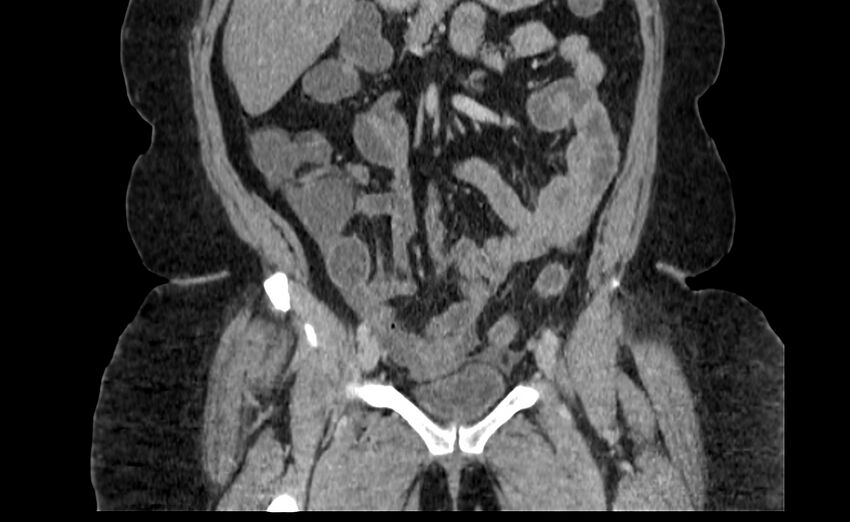 Appendix mucocele (Radiopaedia 41222-44033 B 28).jpg