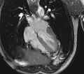 Arrhythmogenic right ventricular cardiomyopathy (Radiopaedia 39806-42237 D 84).jpg