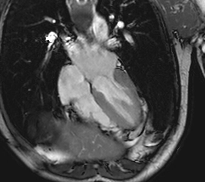 File:Arrhythmogenic right ventricular cardiomyopathy (Radiopaedia 39806-42237 D 84).jpg