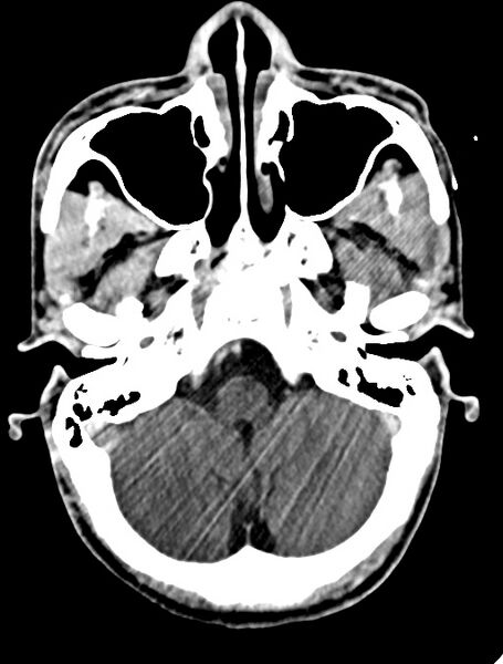 File:Arrow injury to the face (Radiopaedia 73267-84011 Axial C+ delayed 37).jpg