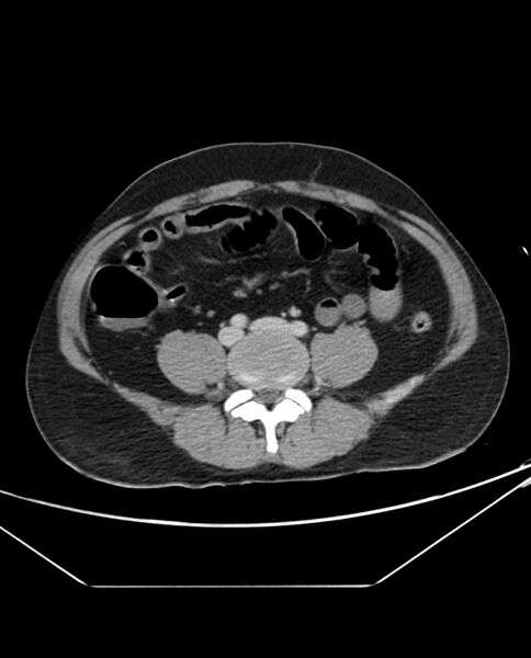 File:Arterial occlusive mesenteric ischemia (Radiopaedia 84641-100054 A 78).jpg