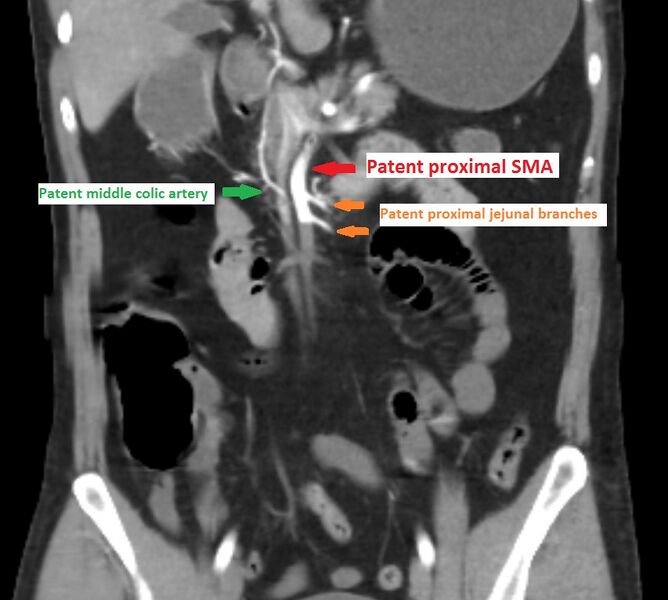 File:Arterial occlusive mesenteric ischemia (Radiopaedia 84641-100063 Coronal arterial 1).jpg