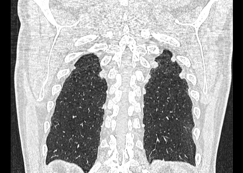 Asbestos pleural placques (Radiopaedia 57905-64872 Coronal lung window 252).jpg
