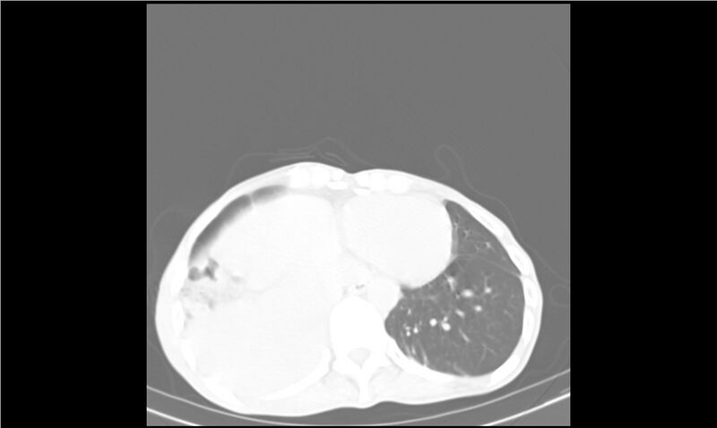 File:Aspergilloma (Radiopaedia 20788-20701 Axial lung window 30).jpg