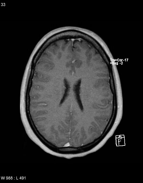 File:Astroblastoma (Radiopaedia 39792-42217 Axial T1 C+ 32).jpg