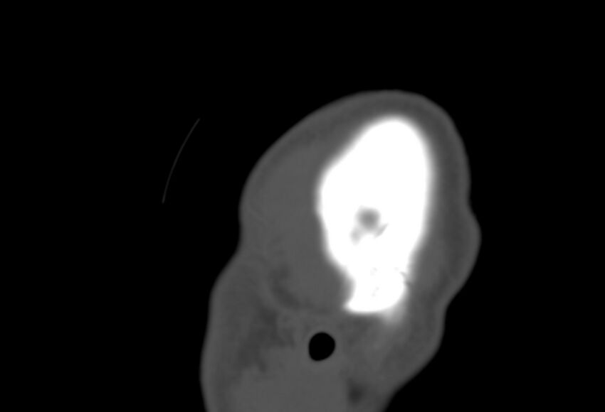 Asymptomatic occipital spur (Radiopaedia 87753-104201 Sagittal bone window 309).jpg